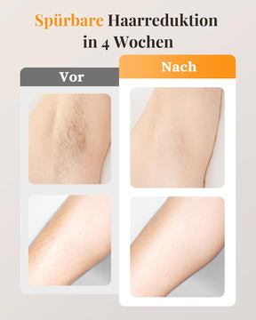 IPL Geräte Haarentfernung Mit Gefrierfunktion, 999,900 Lichtimpulse 9 Intelligente Energiestufen Haarentfernung Laser, Schmerzfreie Haarentfernungsgerät Für Männer, Frauen, Körper Zu Hause